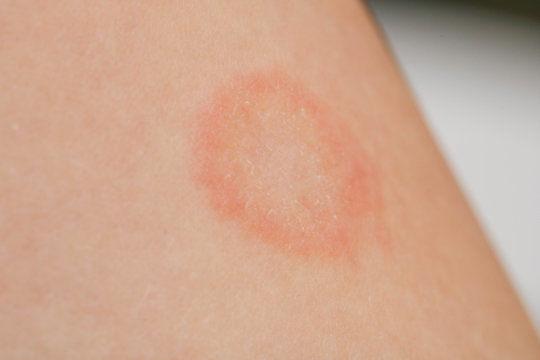 白癬菌感染の症状