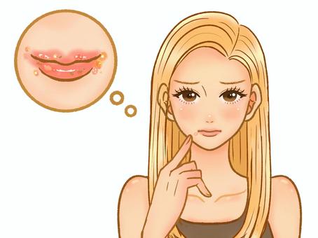 口唇ヘルぺス