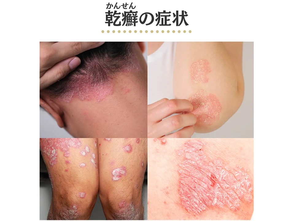 乾癬の症状